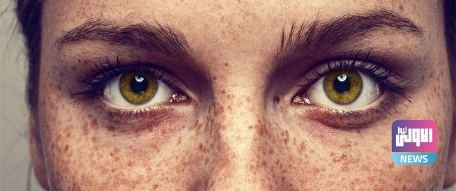 ماهو النمش الخطير؟ 1 2D671624 AC04 439B AD66 CB0A0E4D0F21