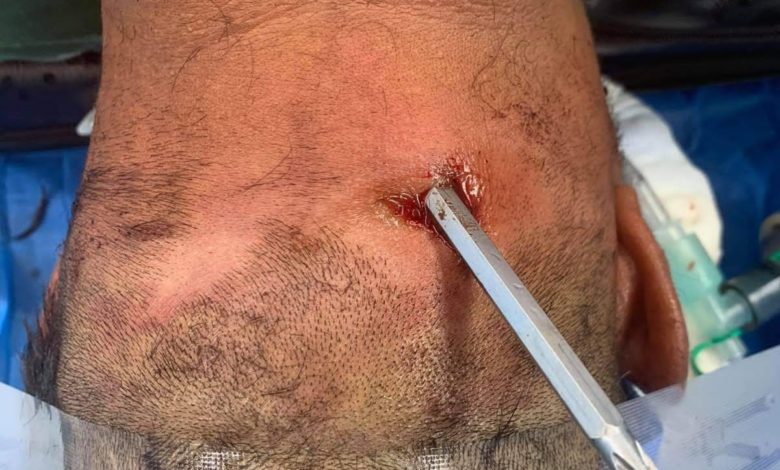 انقاذ رجل أصيب بمفك براغي "درنفيس" بالفقرات العنقية ونفذ للحبل الشوكي 15 D9BBF1E4 8F24 40F6 B85B 2382D4FB1E43