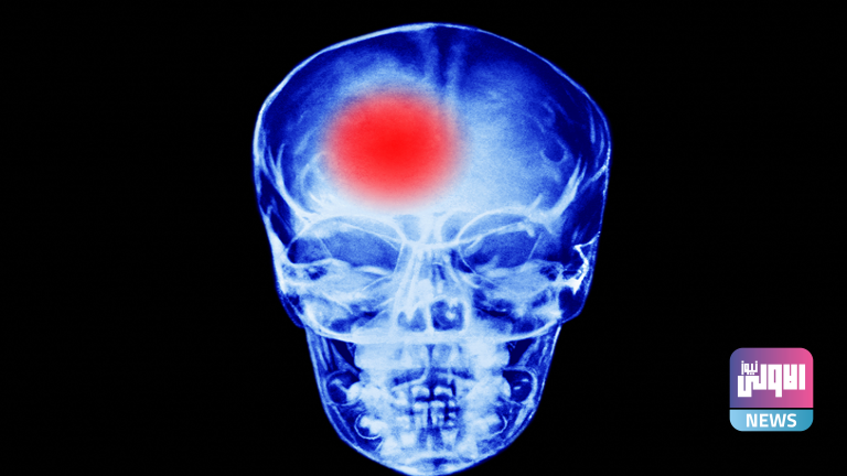 مشروب يمكن أن يزيد من خطر الإصابة بسكتة دماغية خمسة أضعاف 1 620bc0c14c59b70700514b13