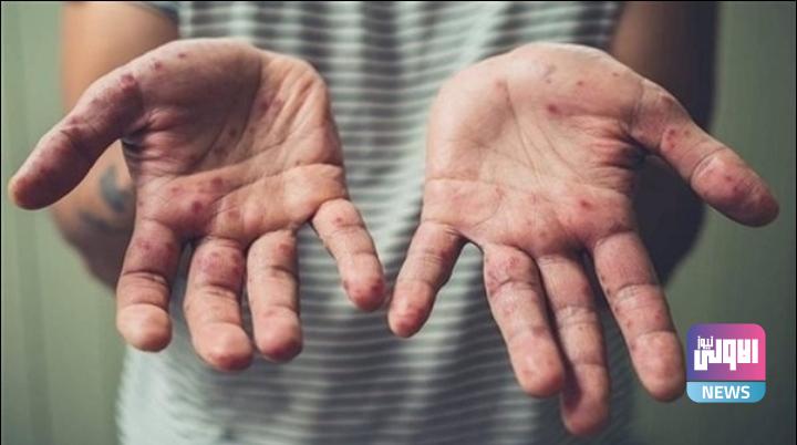 الامارات تسجل ٣ اصابات جديدة بجدري القردة 1 Screenshot ٢٠٢٢٠٥٢٩ ٢٠٣٥٤٨ Facebook