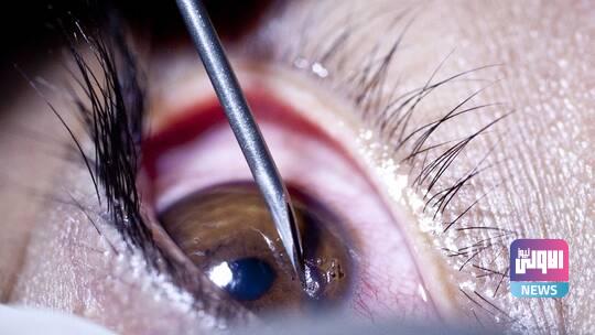 زرع قرنية اصطناعية لعشرين مريضا 1 62f5f32c4236045ef00c4b93